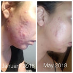 Super Acne Fighter Organic Acne Treatment With Essential Oils For Clear Skin Butter Me Up Organics 