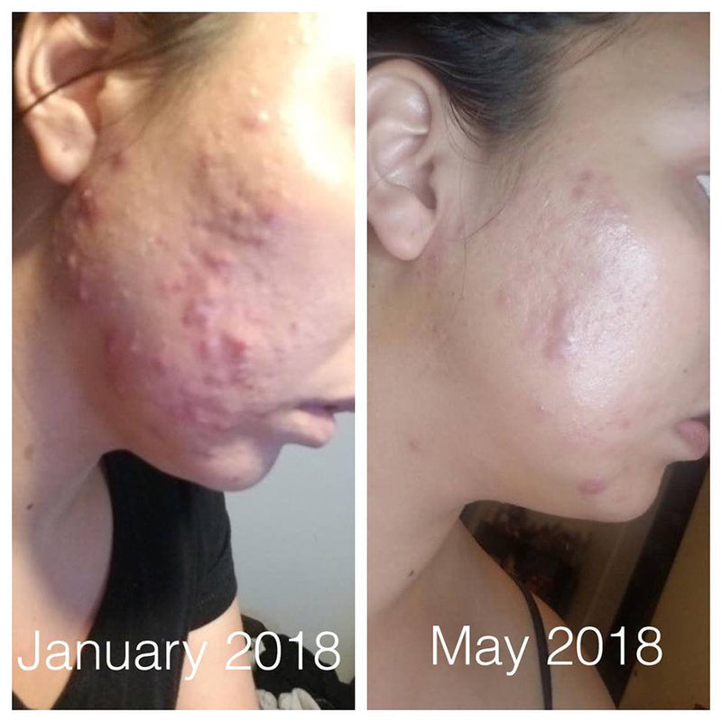 Before and after results of using Super Acne Fighter showing significant reduction in acne.