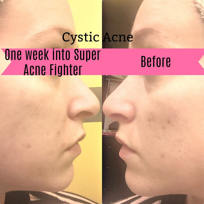 Before and after using Super Acne Fighter for cystic acne treatment.