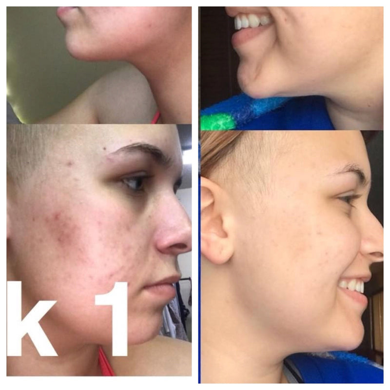 Organic acne treatment serum before and after results showing improved clear skin.